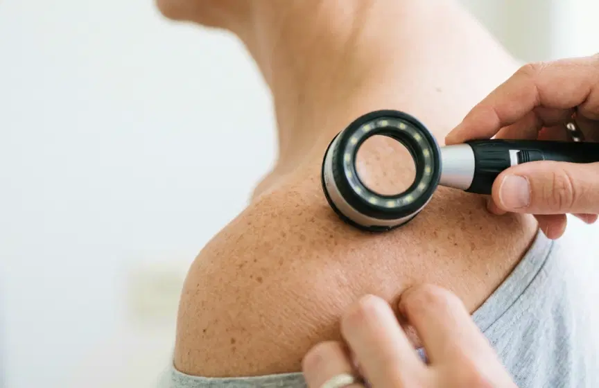 A clinician examines a mole on a patient's shoulder through a handheld dermatoscope.