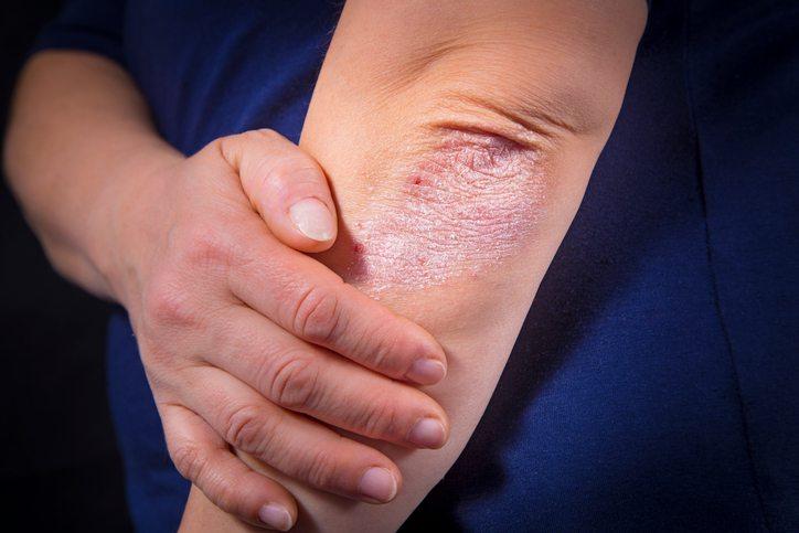 New 23andMe+ Premium Report on Psoriasis