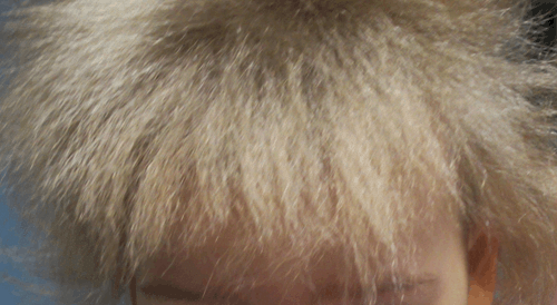 Understanding Uncombable Hair Syndrome